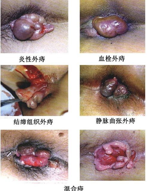 女性痔疮的危害 女性痔疮症状有4个表现（图片）