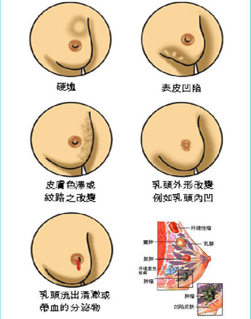 乳腺癌的早期症状（图片）