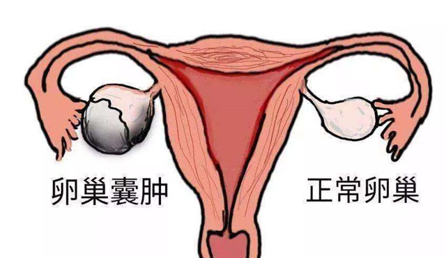 详解卵巢囊肿是怎么来的