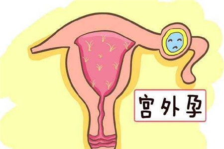 宫外孕症状