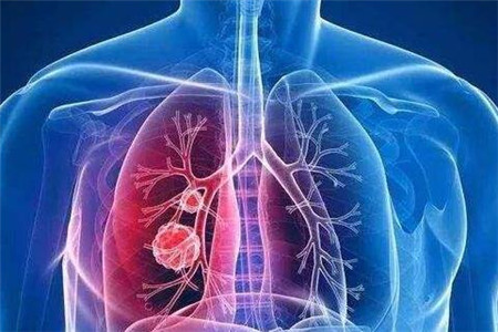 肺癌晚期