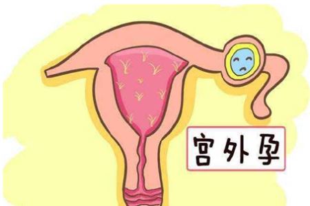 女人宫外孕