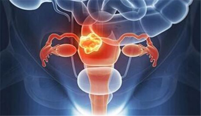 女人得卵巢囊肿的原因以及治疗方法