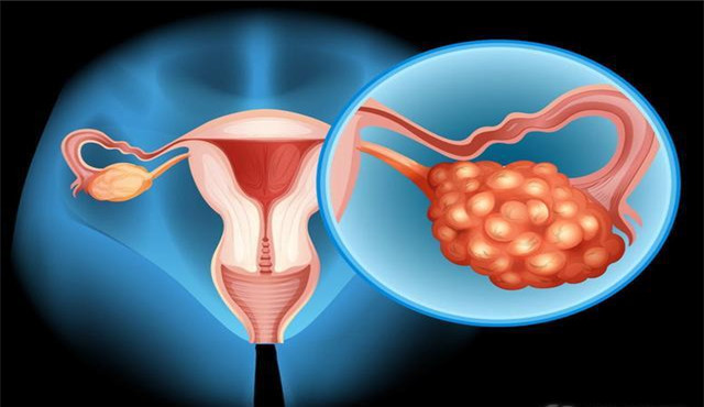 卵巢癌晚期的三大典型症状