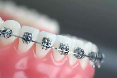 牙齿矫正方法