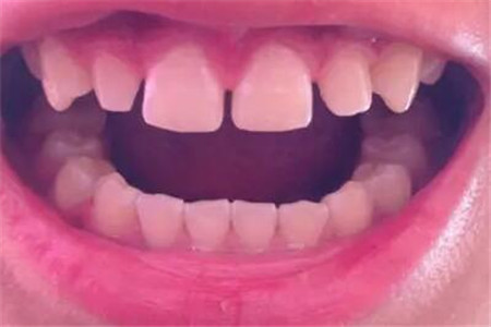 牙缝