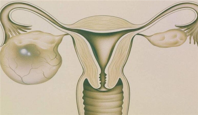 卵巢囊肿的原因以及处理方法