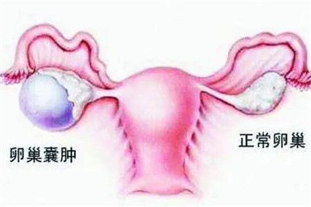 卵巢囊肿