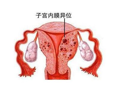子宫内膜异位症