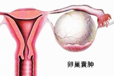卵巢囊肿因素
