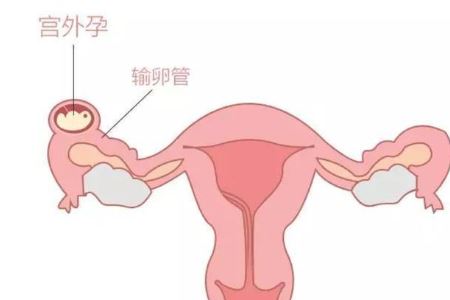 宫外孕预防