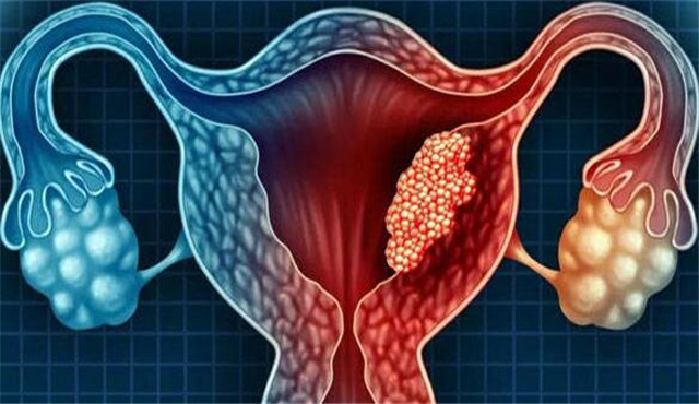 子宫内膜癌的五个常见信号
