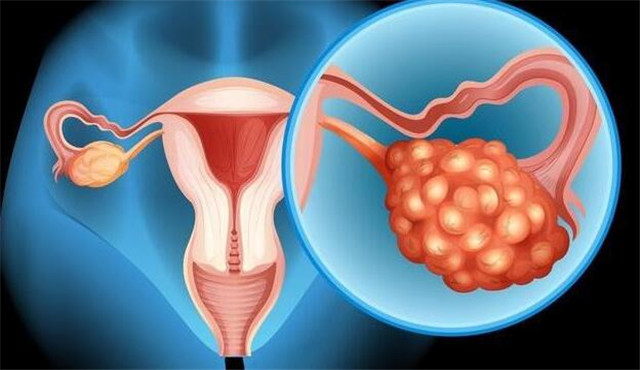 女性多囊卵巢综合症的四个常见原因