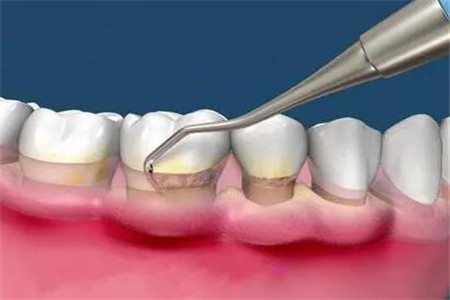 牙龈炎的四个有效预防方法