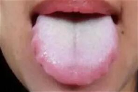 舌苔发白