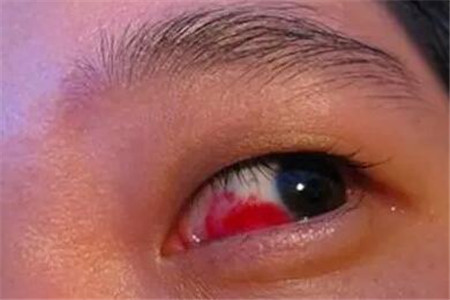 红眼病的预防