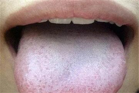 舌苔异常