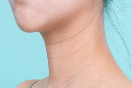 颈纹产生的原因，五种方法有效预防和改善