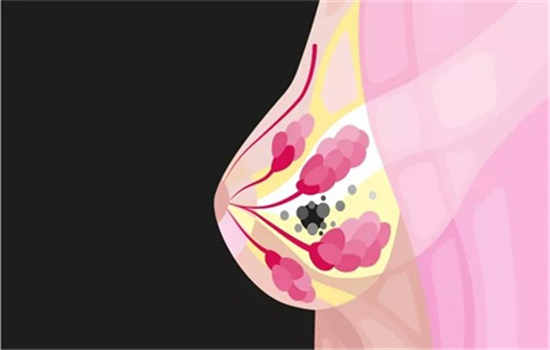 九价疫苗能不能预防乳腺癌