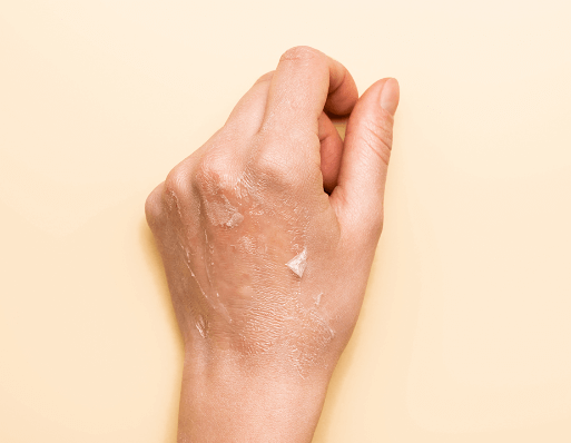身体皮肤干燥脱皮如何改善 有什么预防措施