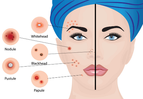脸上有痘痘该如何去保养皮肤？