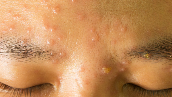 脸部皮肤粗糙如何解决 推荐这7点帮助皮肤恢复水润