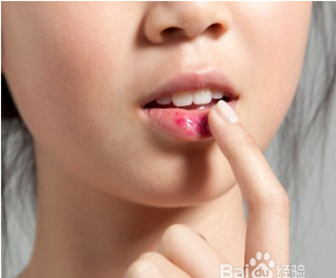 冬季嘴唇干裂脱皮是什么原因，该怎么办 吃什么好？